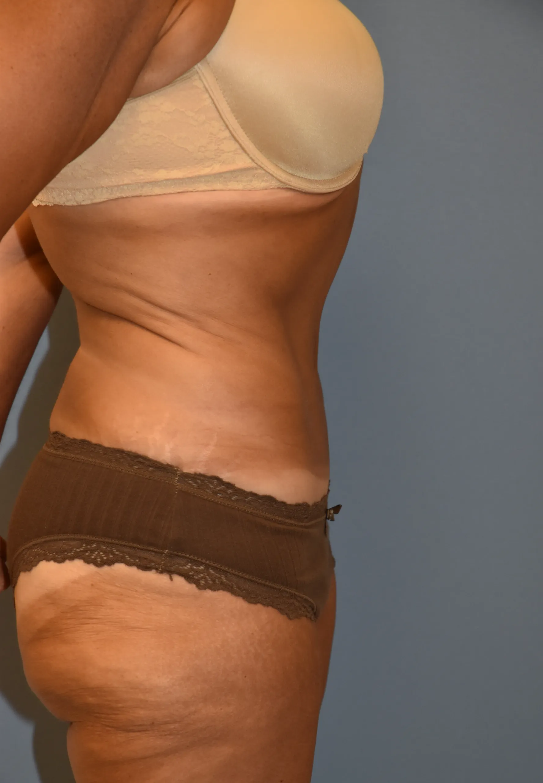 After Fleur de Lis Tummy Tuck - side view