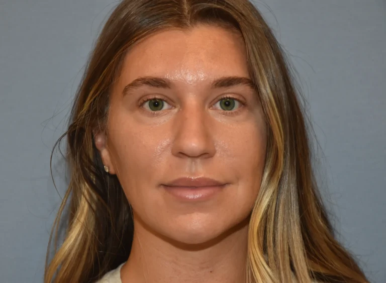 Rhinoplasty before - front view