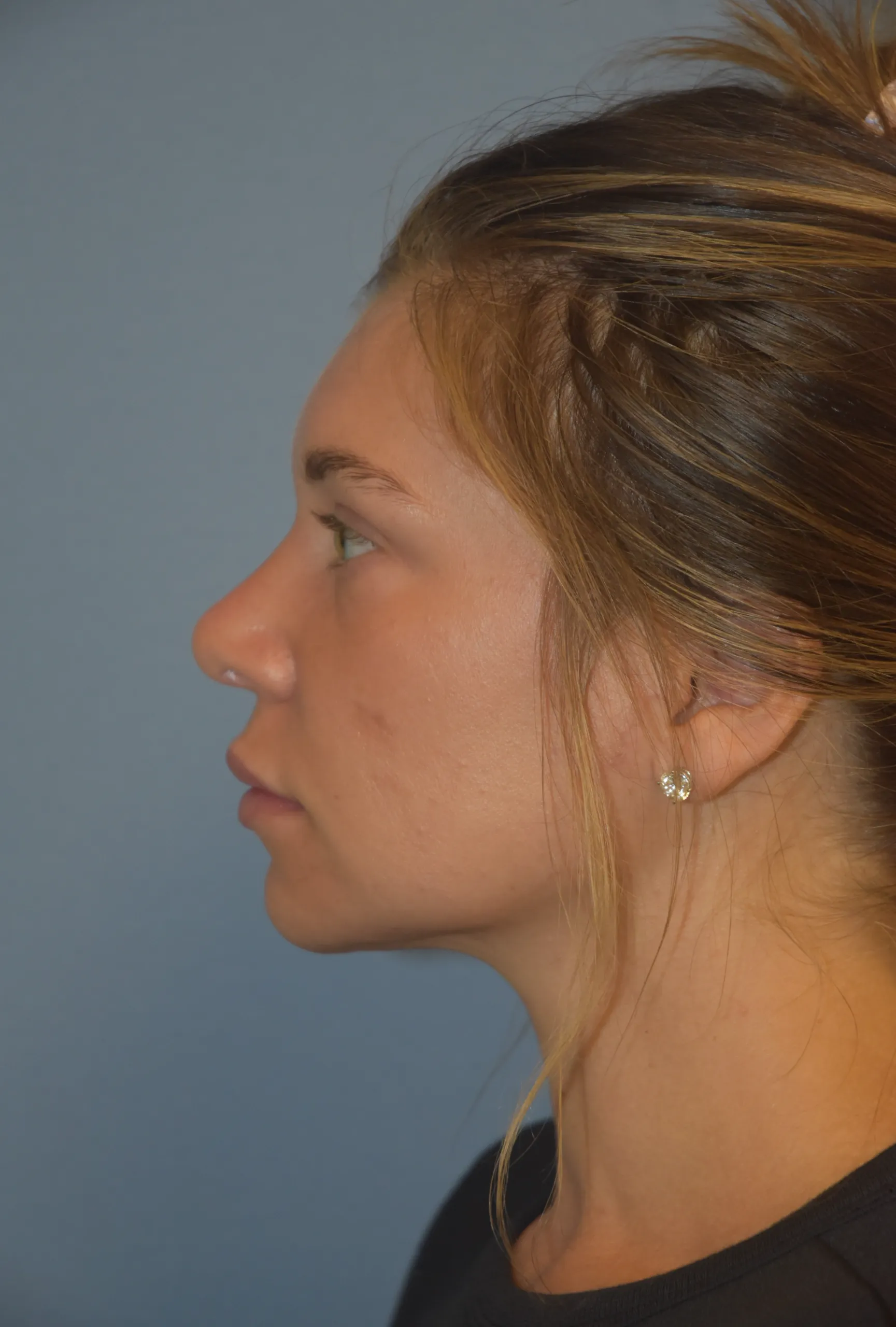 Rhinoplasty after - side view facing right