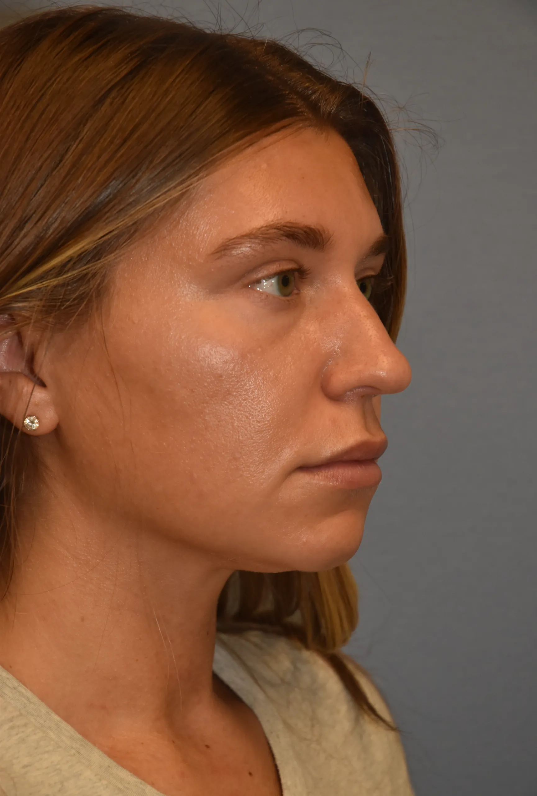 Rhinoplasty before - oblique view facing left