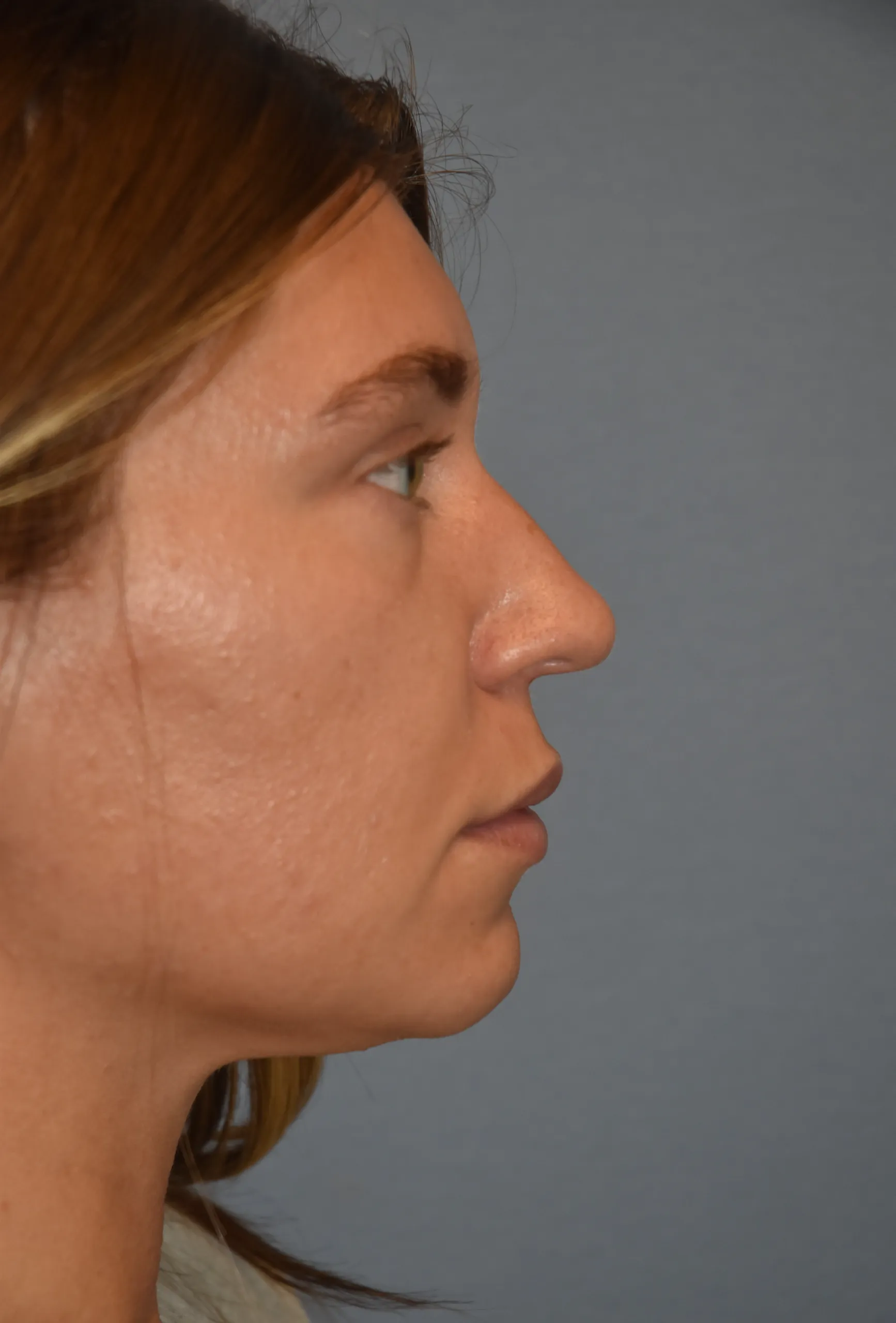Rhinoplasty before - side view facing left