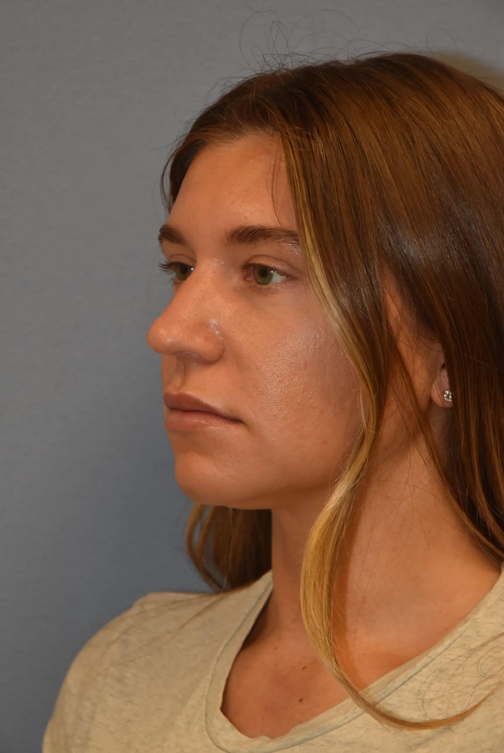 Rhinoplasty before - oblique view facing right