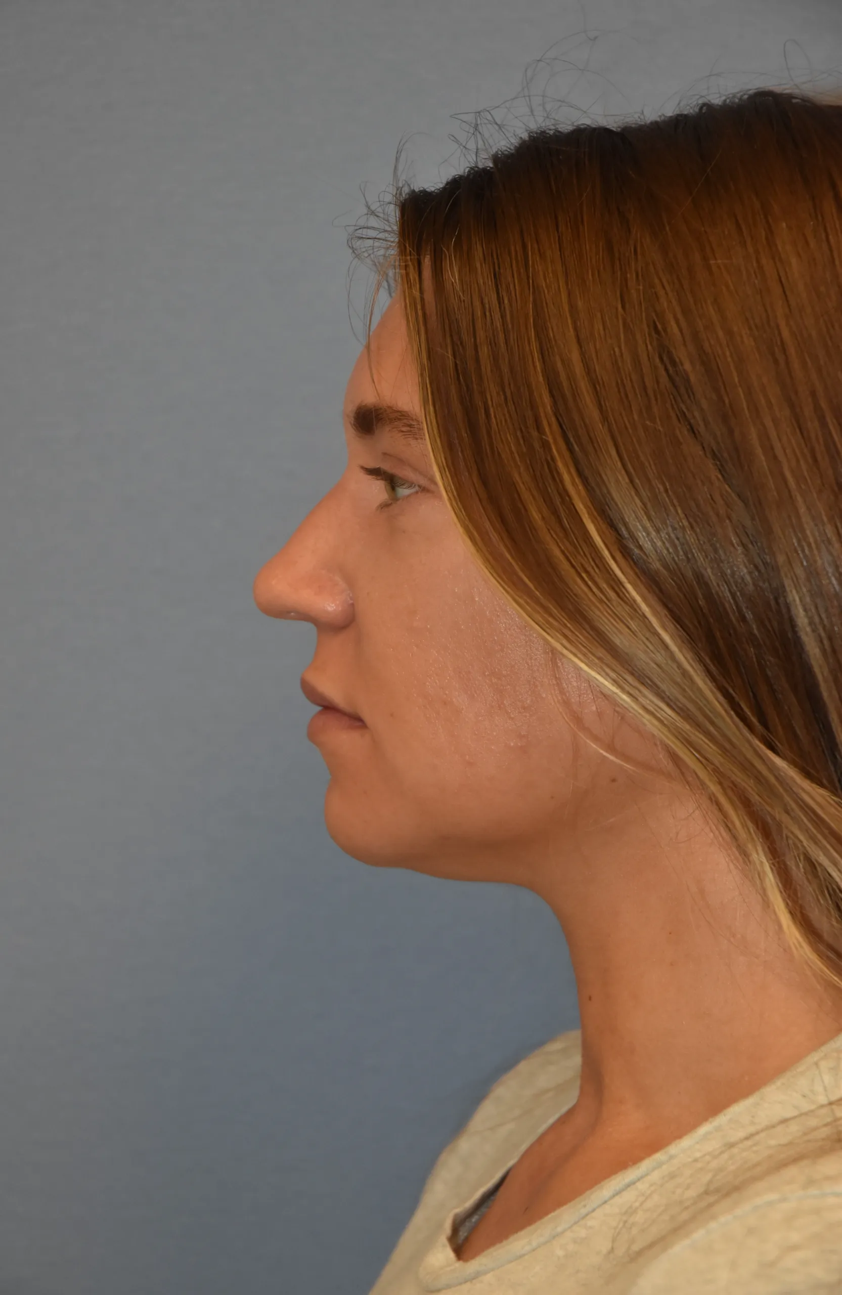 Rhinoplasty before - side view facing right