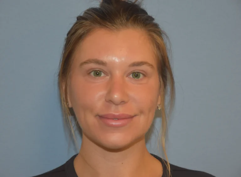 Rhinoplasty after - front view