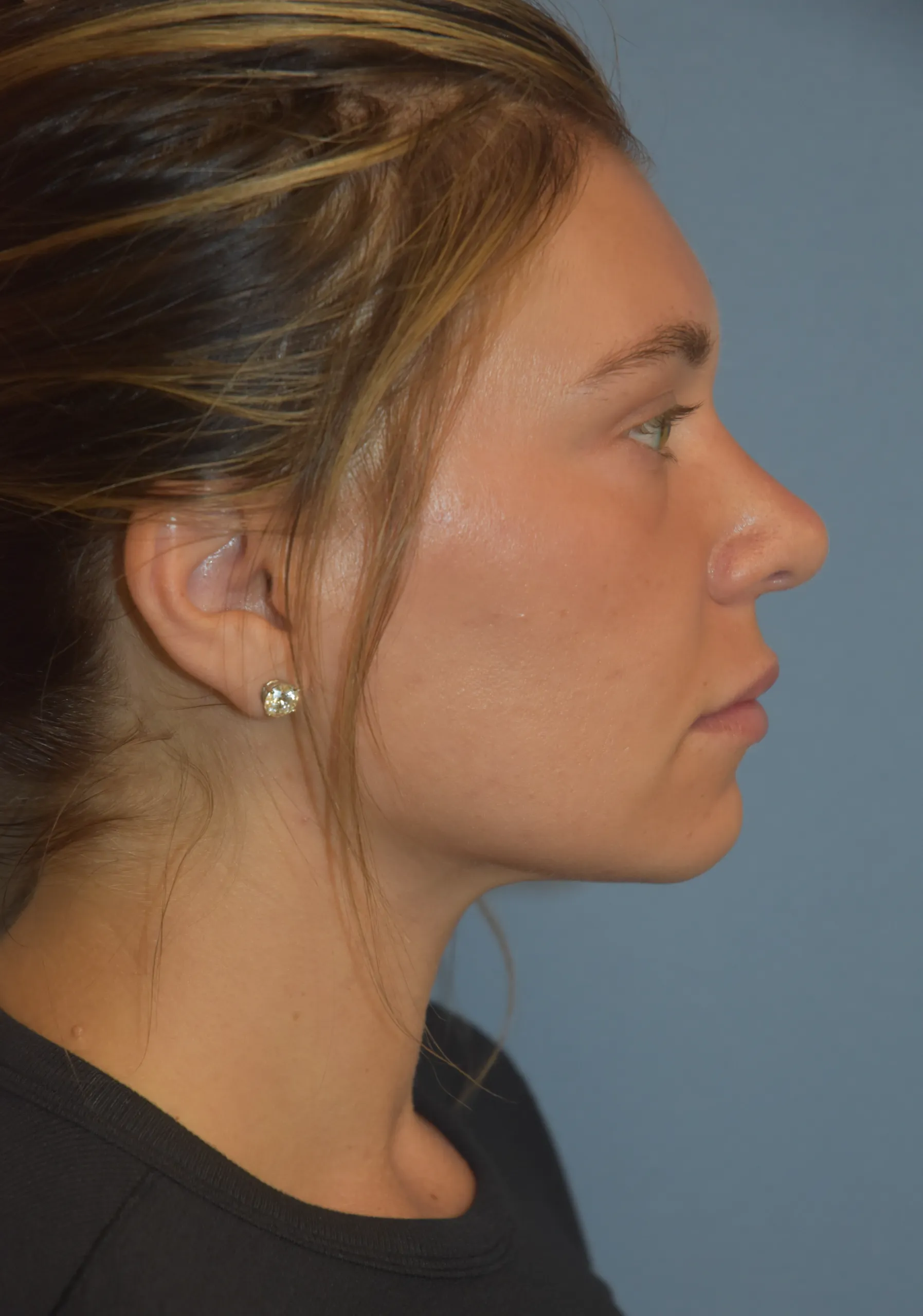 Rhinoplasty after - side view facing left