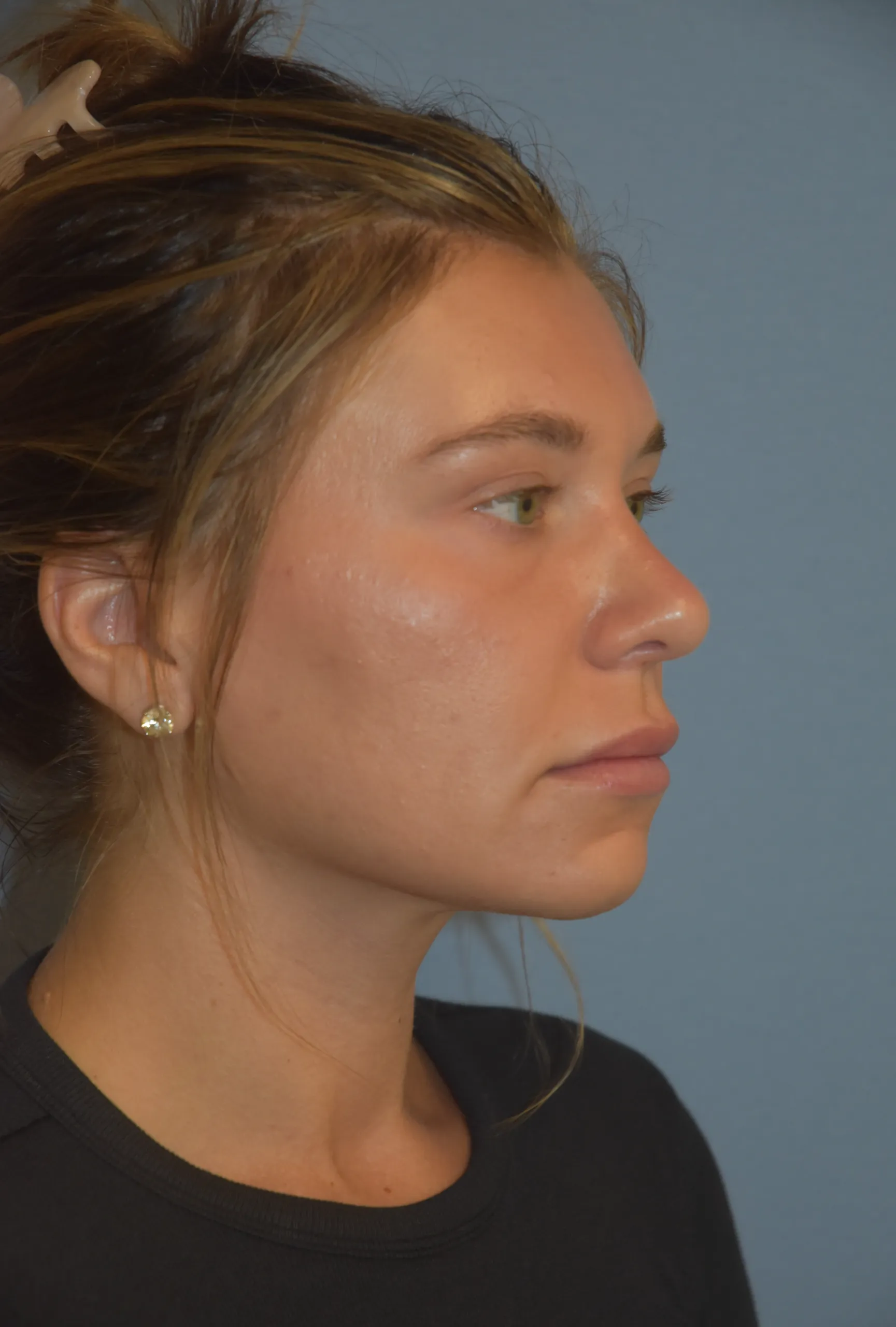 Rhinoplasty after - oblique view facing left