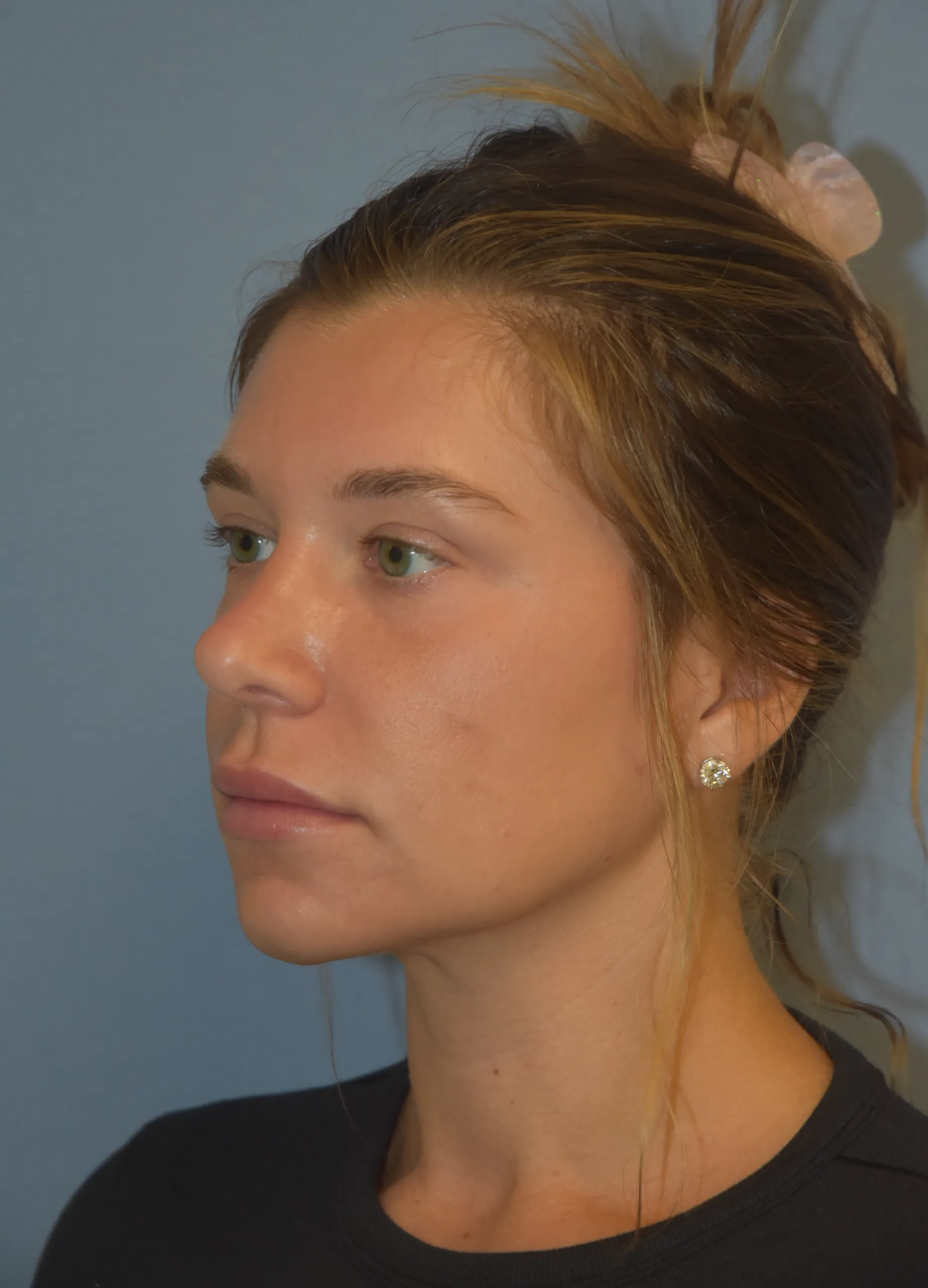 Rhinoplasty after - oblique view facing right
