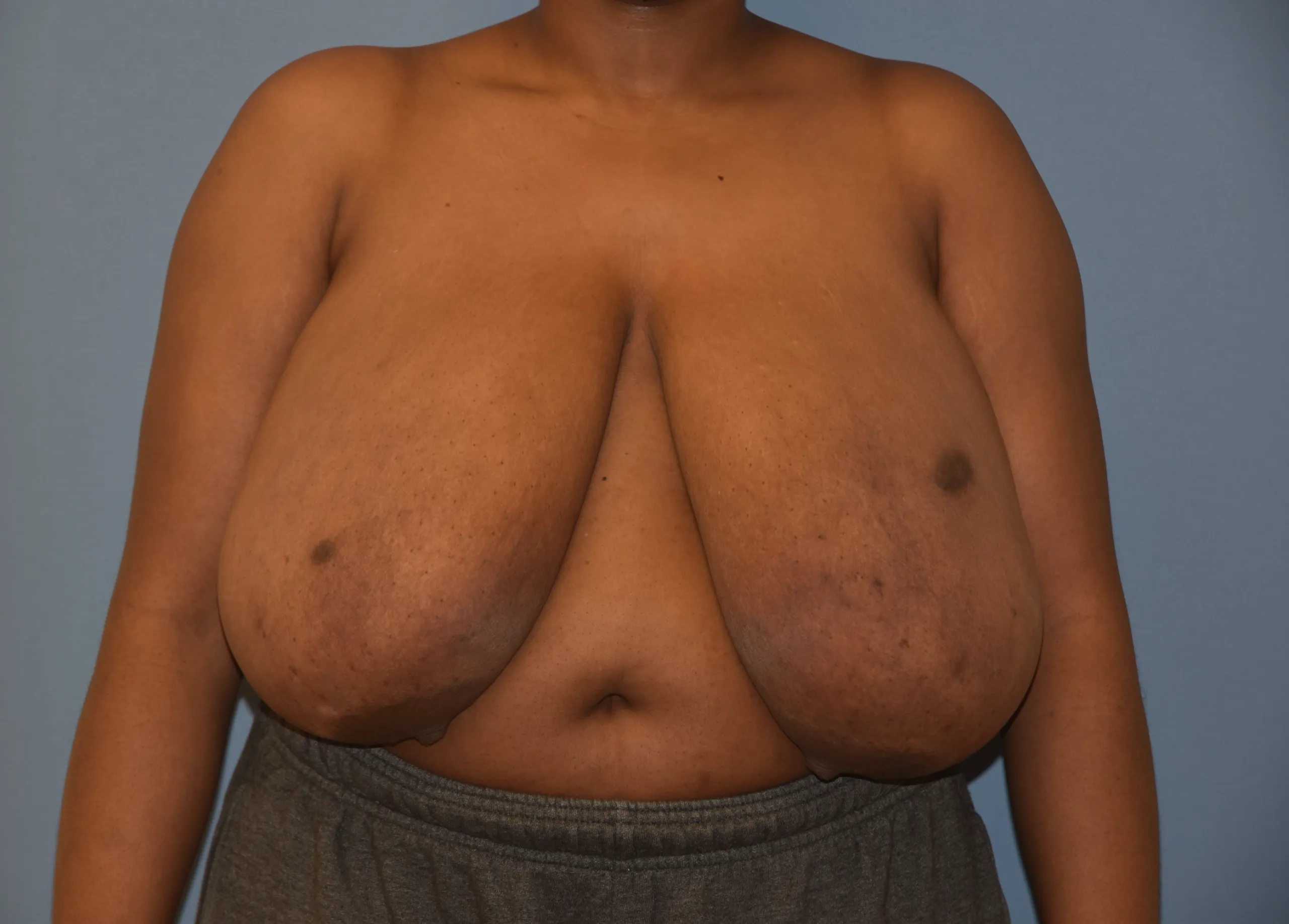 Breast Reduction Before - Front View