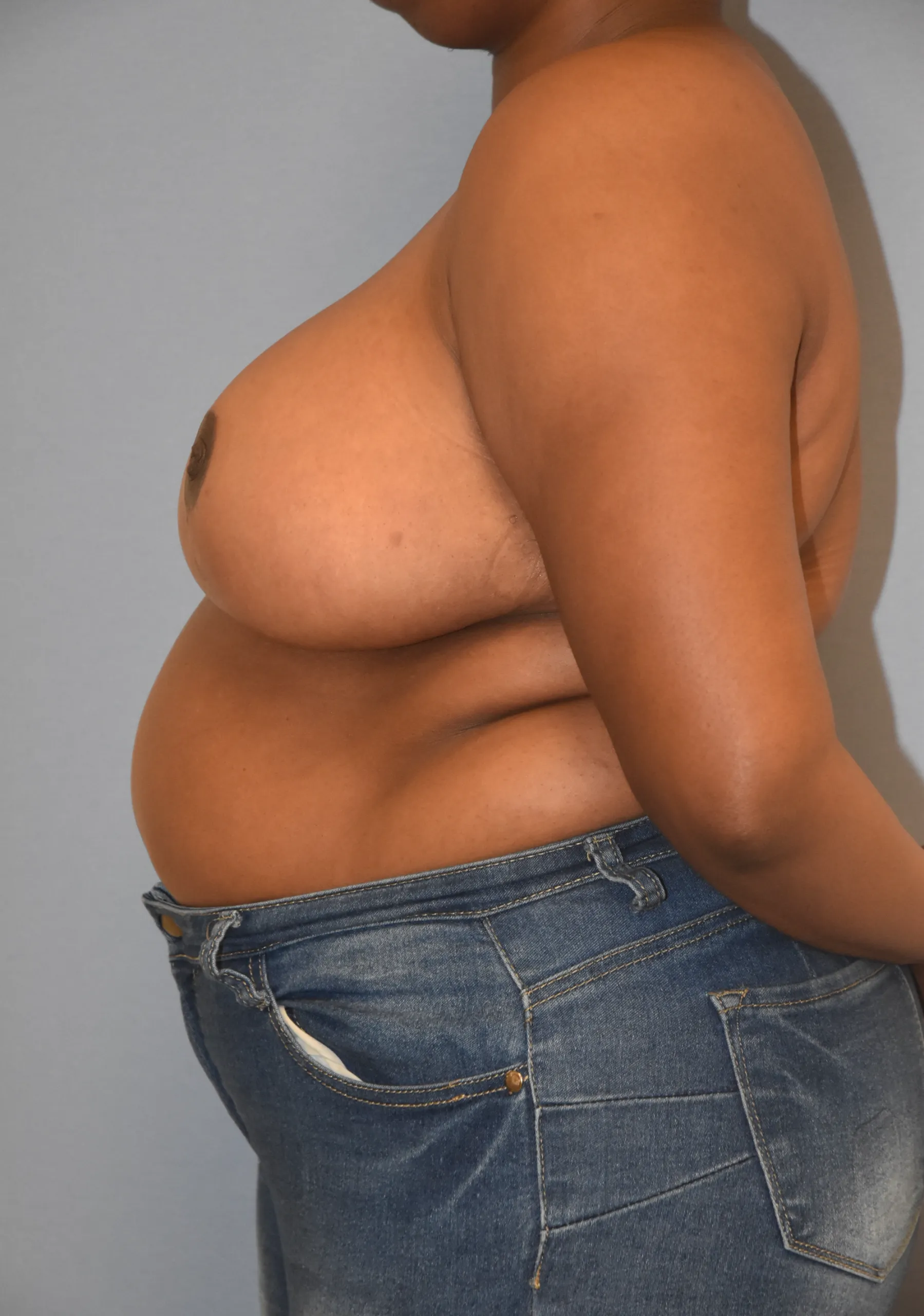 Breast Reduction After - Side View Facing Right