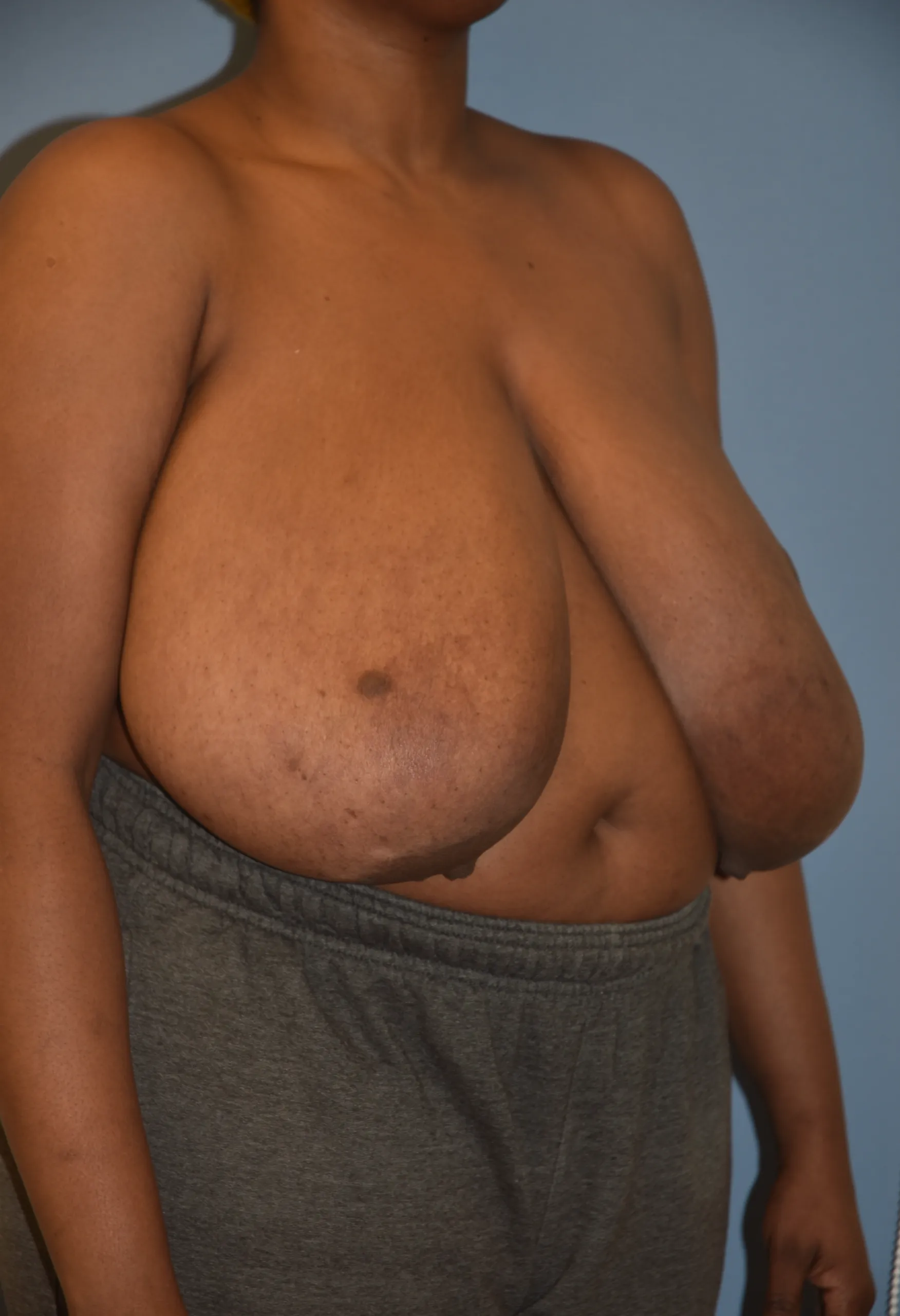 Breast Reduction Before - Oblique View Toward Left