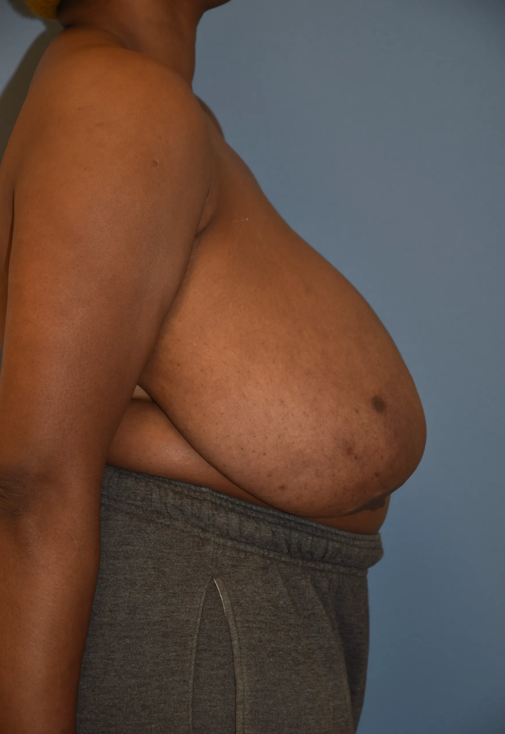 Breast Reduction Before - Side View Facing Left