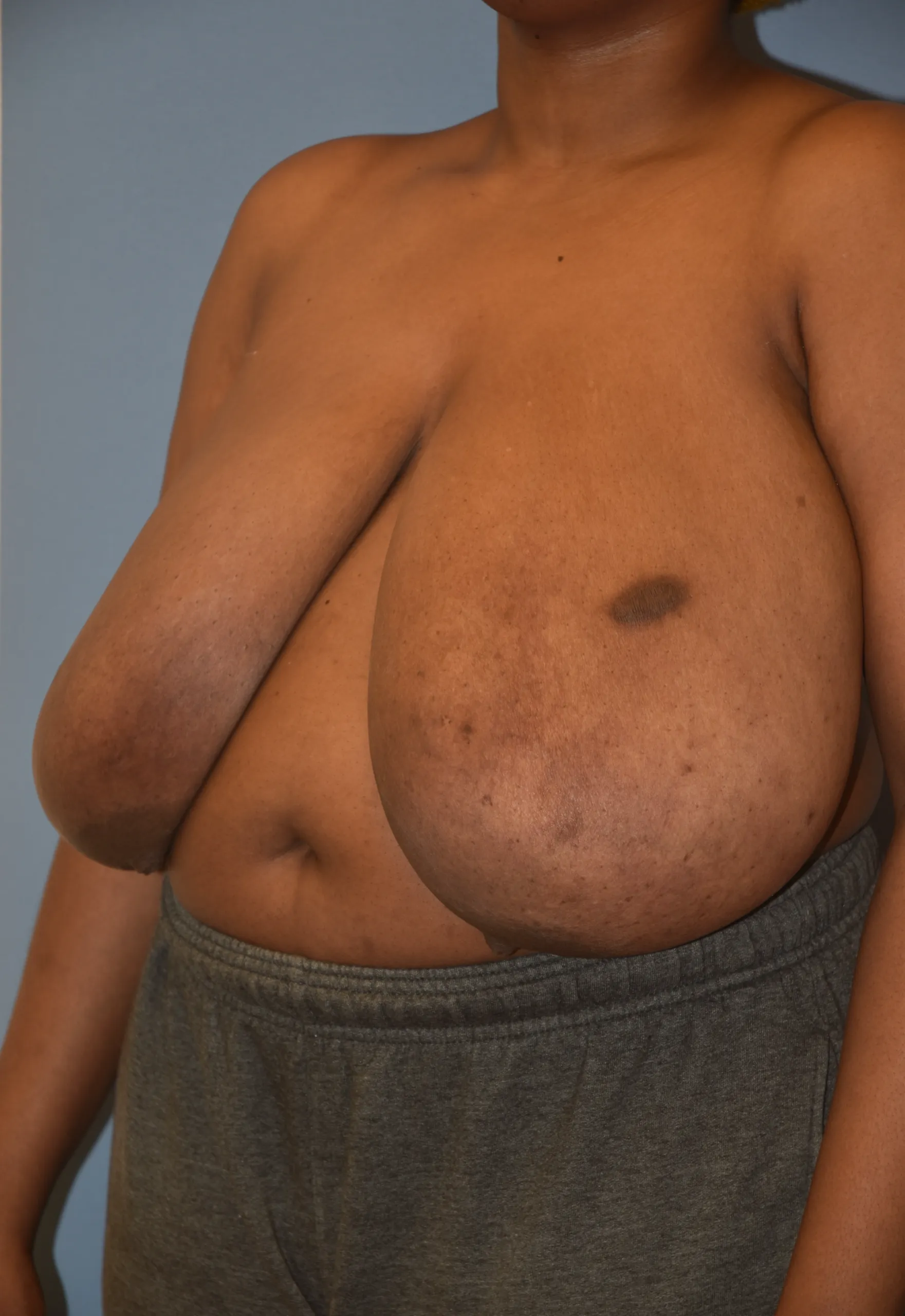 Breast Reduction Before - Oblique View Toward Right