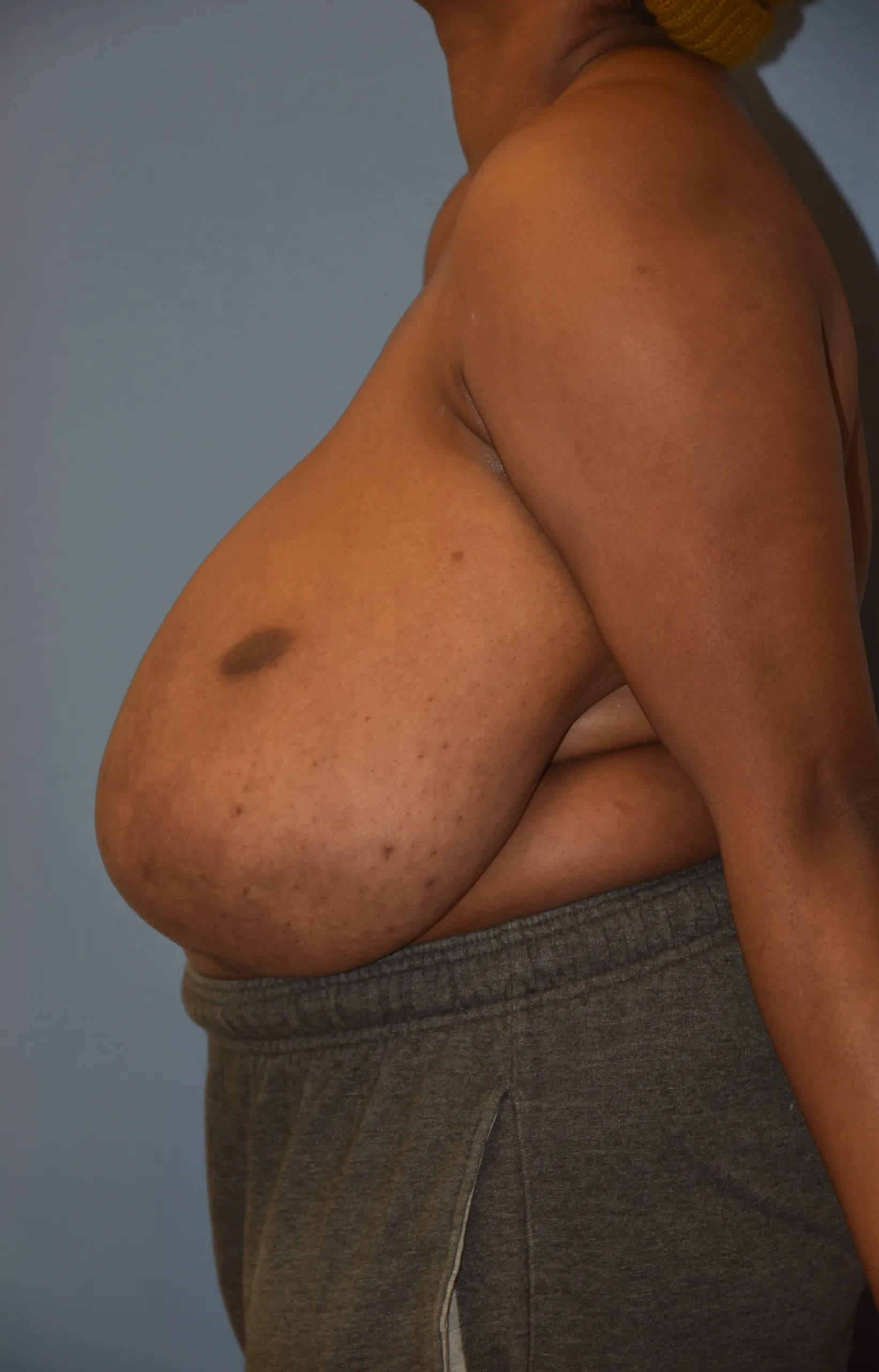 Breast Reduction Before - Side View Facing Right