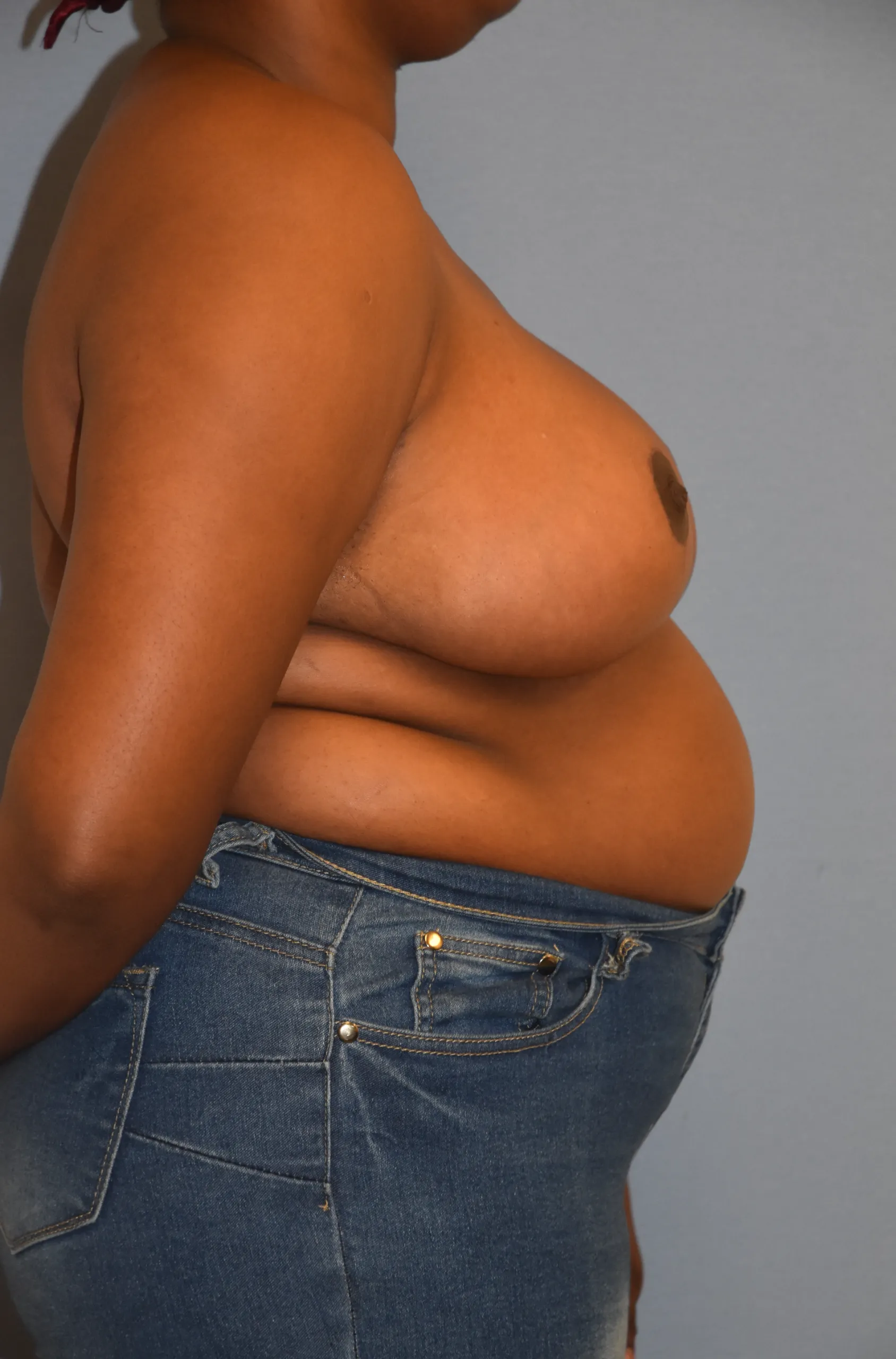 Breast Reduction After - Side View Facing Left